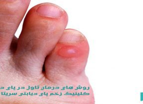 درمان تاول پای دیابتی