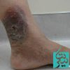 با زخم عروقی چه کار کنیم؟