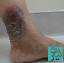 با زخم عروقی چه کار کنیم؟