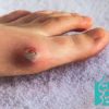 موارد منع شده در درمان زخم دیابتی