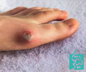 موارد منع شده در درمان زخم دیابتی