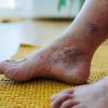 چرا زخم پای دیابتی سیاه میشود؟