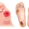 خطرات دیر مراجعه کردن به کلینیک زخم