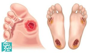 خطرات دیر مراجعه کردن به کلینیک زخم